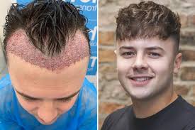 Complete Turkey Hair Transplant Packages: What’s Included? post thumbnail image